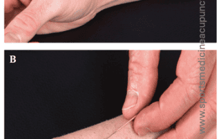 LU 7 (lieque): Location & Threading Needle Technique | SPORTSMEDICINEACUPUNCTURE.COM