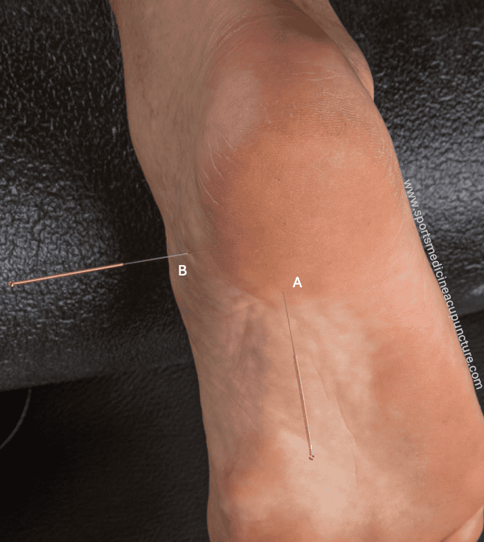 Case Study: Misdiagnosed Plantar Fasciitis Pain (Inferior Calcaneal Nerve Entrapment or Baxter’s Neuropathy) | SPORTSMEDICINEACUPUNCTURE.COM