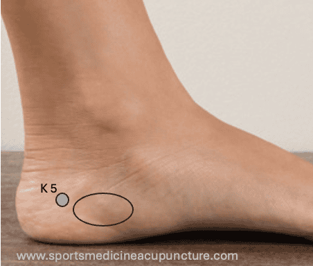 Case Study: Misdiagnosed Plantar Fasciitis Pain (Inferior Calcaneal Nerve Entrapment or Baxter’s Neuropathy) | SPORTSMEDICINEACUPUNCTURE.COM
