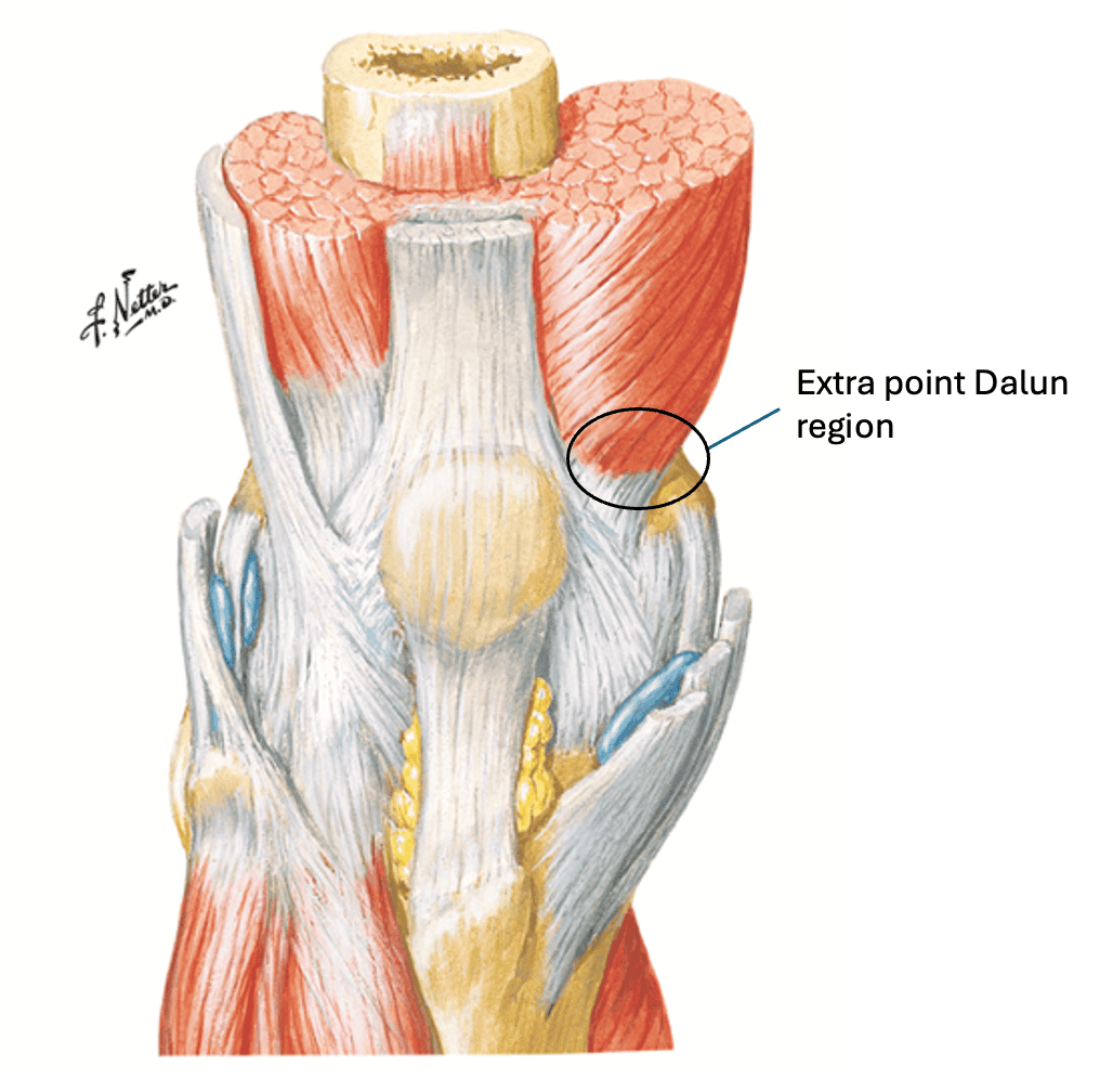 Extra Point Dalun — Medial & Anterior Knee Pain | SPORTSMEDICINEACUPUNCTURE.COM